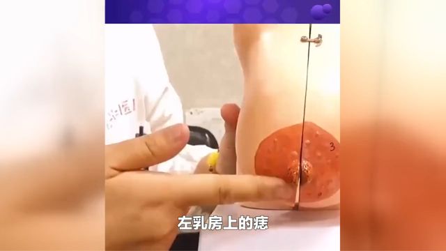 左乳房有痣代表什么预兆 女人左边乳房有痣富贵