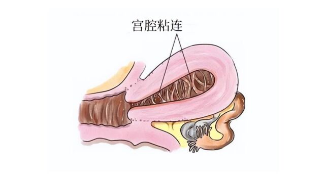 宫腔粘连手术后,不想粘连复发,这件事很关键