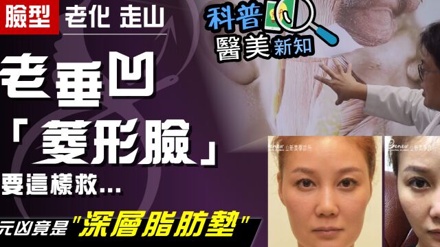 【科普医美新知】脸型老化走样!瓜子脸变「菱形脸」... 解剖学大师最新国际研究解密:竟是「它」惹的祸!