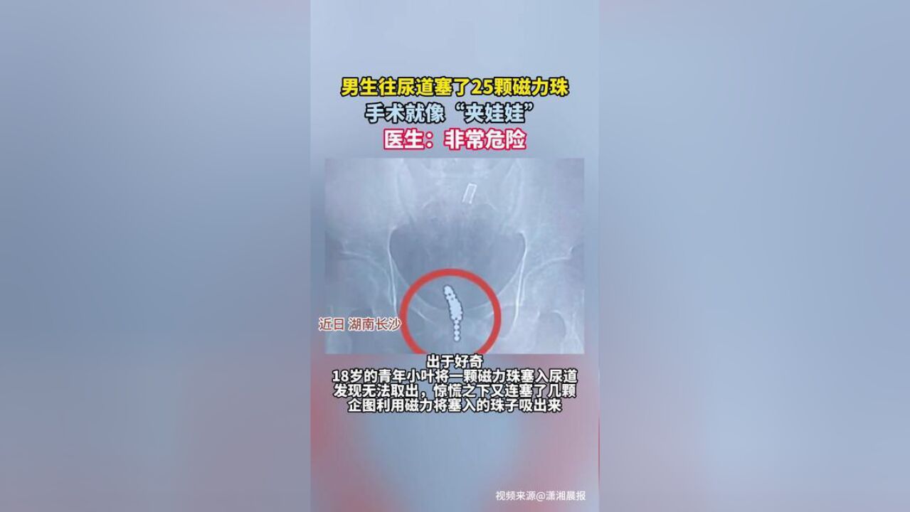 男生往尿道塞了25颗磁力珠,手术就像“夹娃娃”,医生:非常危险.