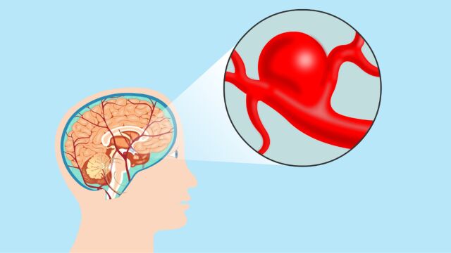 临床上常见的“脑血管”疾病有哪些呢?医生详细解答