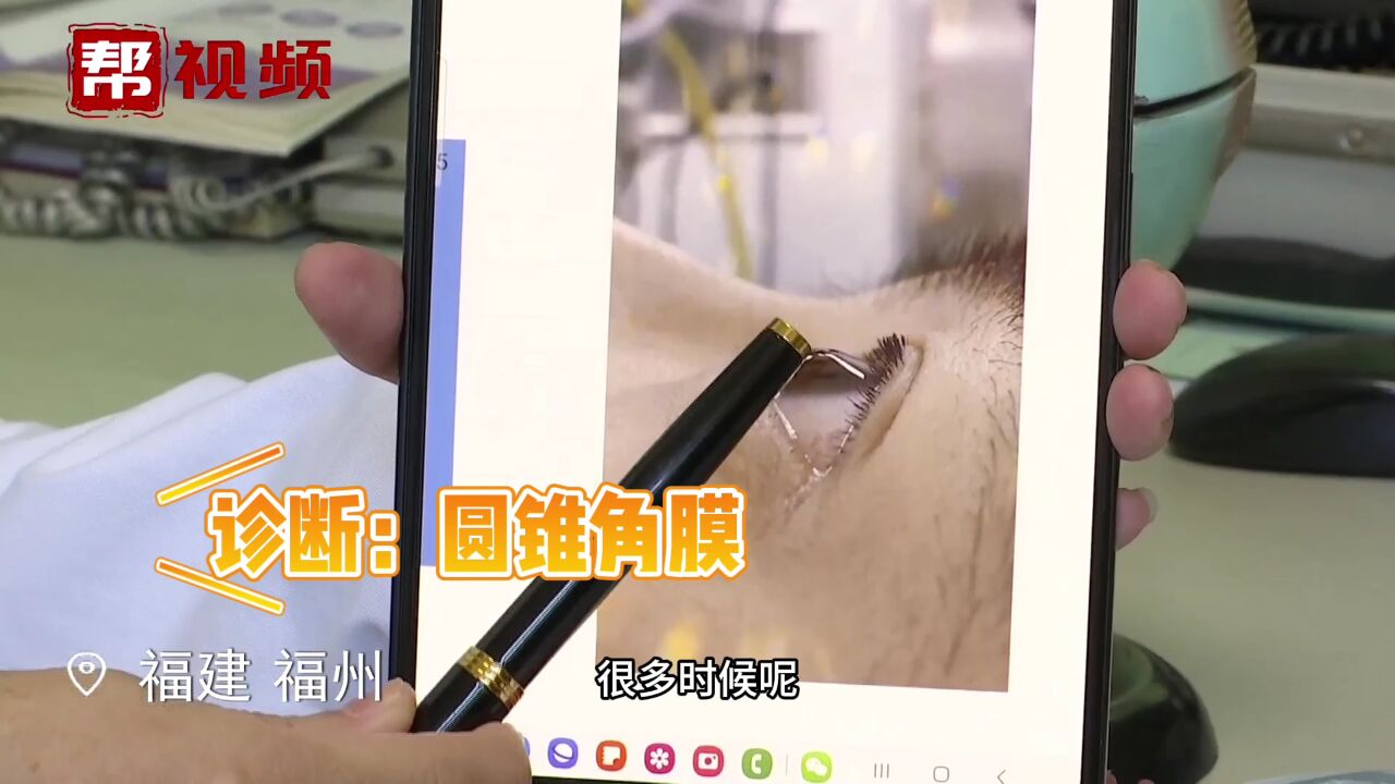 女子视物模糊后竟有失明风险 医生:角膜形变成圆锥