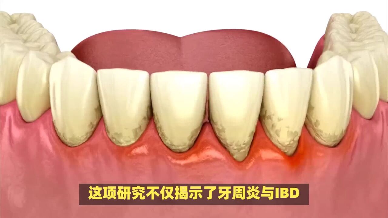 首都医科大学研究揭示,牙周炎与肠道健康的新关联