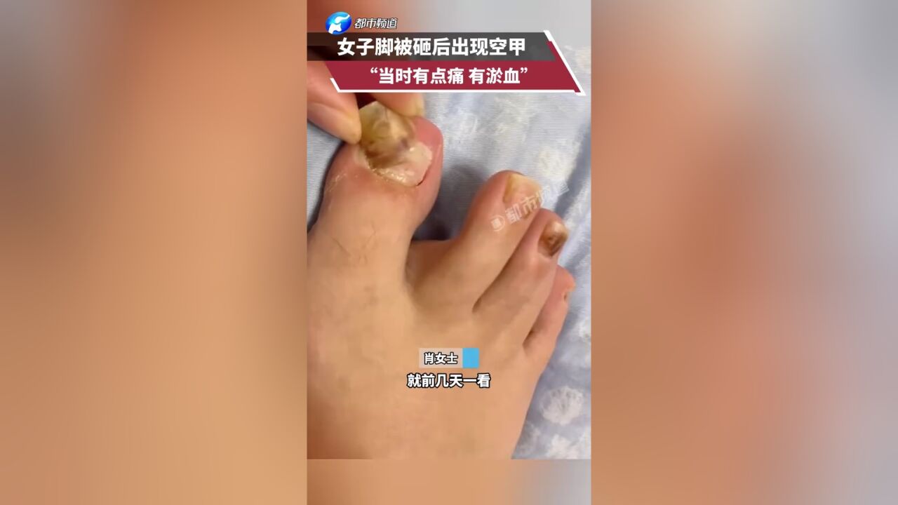 女子脚被砸后出现空甲 “当时有点痛 有淤血”