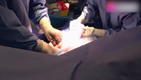 产房实拍孕妇剖腹产生子全过程，宝宝睁开眼睛那一刻真是太感人了 - 腾讯视频