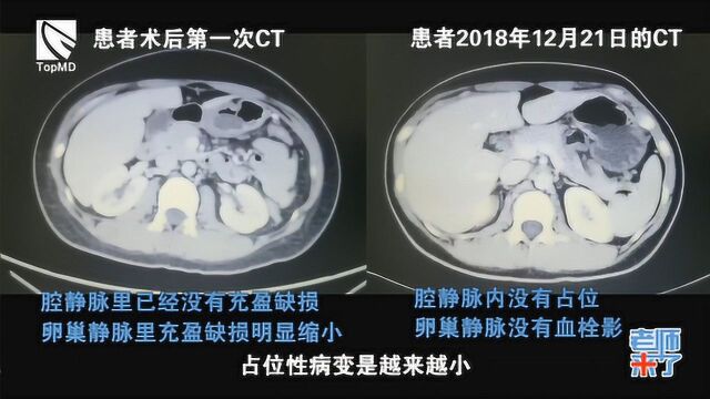 临床经典病案:一例极易误诊的围产期深静脉血栓