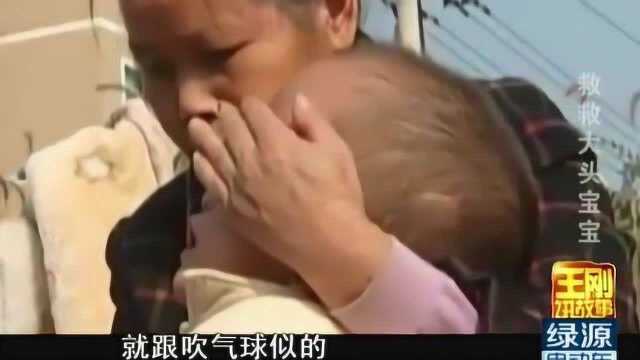 男孩一出生就患上怪病,头巨大无比神似“外星人”,家人都开始准备后事!