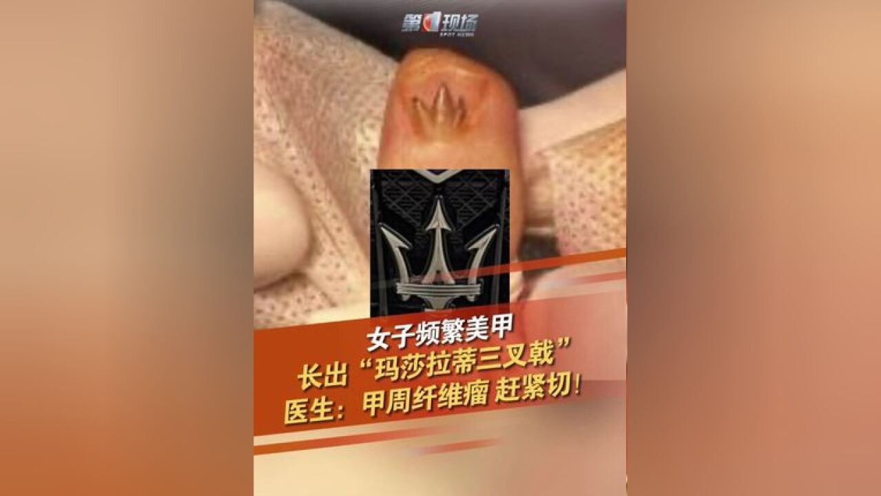 一名24岁的杭州姑娘频繁美甲,经常更换穿戴甲的指甲片,不久前,她发现指甲上突然长了一块多余的“肉”!