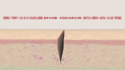 【腾讯视频】 术后创口愈合的全过程