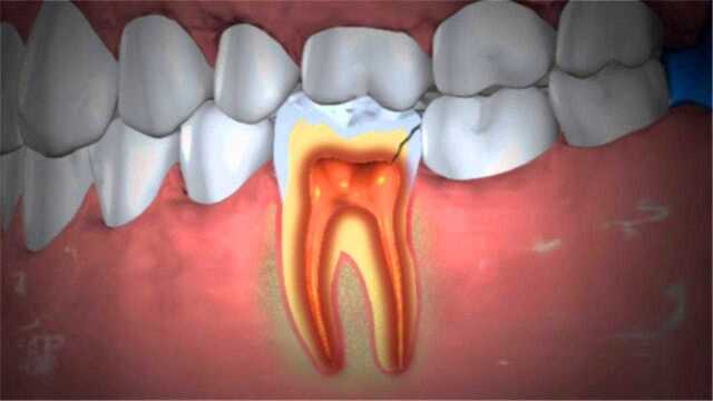 蛀牙真是被“蛀虫”咬的吗?看完整个画面,再也不敢偷懒了