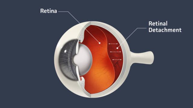 近视者的噩耗,视网膜脱离到底是什么鬼?