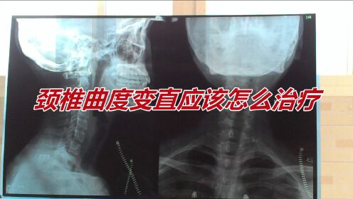 颈椎曲度变直应该怎么治疗 - 腾讯视频