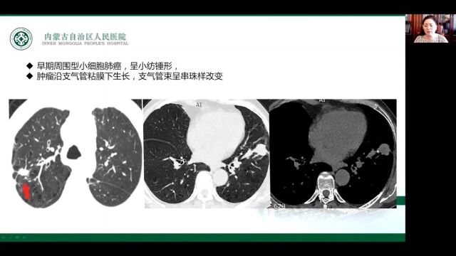 小细胞肺癌影像诊断内蒙古自治区人民医院张晓琴