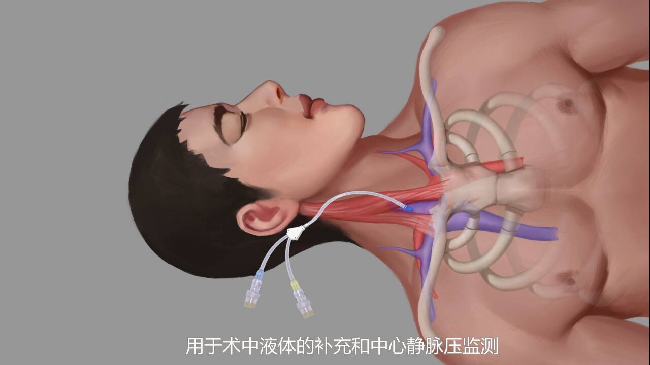 冠心病,冠脉搭桥手术是怎么做的?