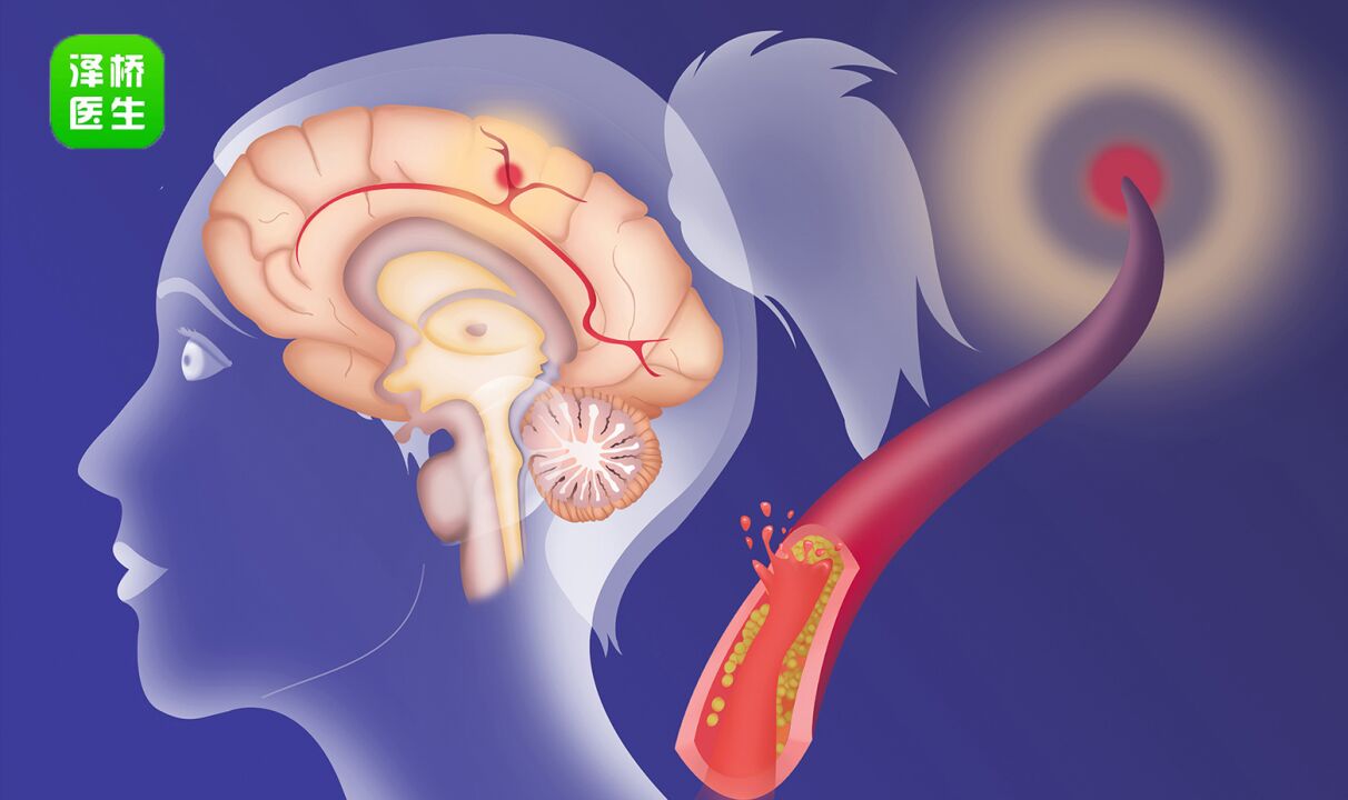 脑卒中患者居家康复有哪些讲究?进来看看你知道多少