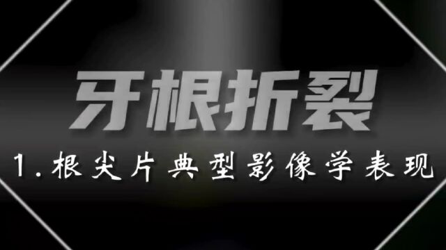 牙根折裂根尖片典型影像学表现