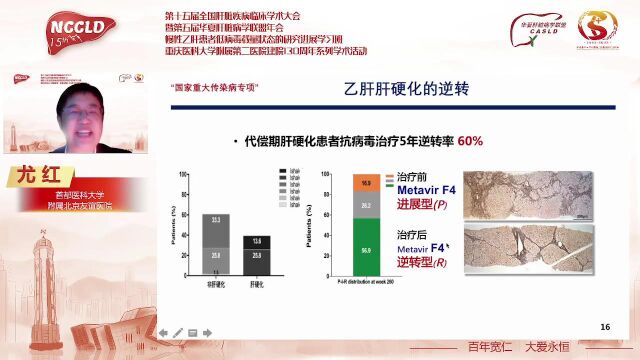 尤红教授:肝硬化门脉高压的逆转:证据和挑战