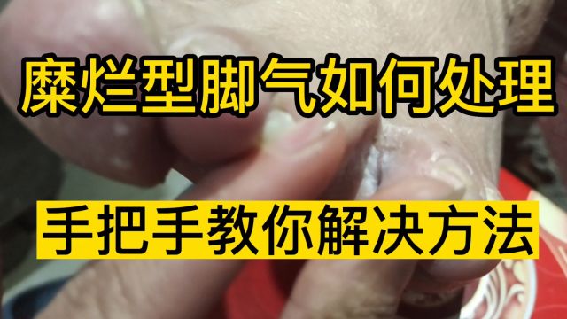 脚趾缝糜烂发痒怎么办?手把手教你正确处理方法