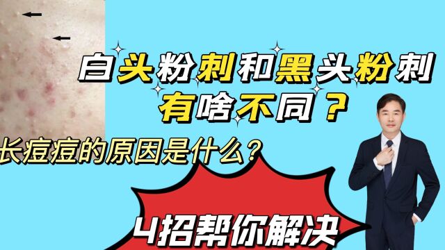 黑头粉刺和白头粉刺有啥不同?长痘痘的原因是什么?4招帮你消除