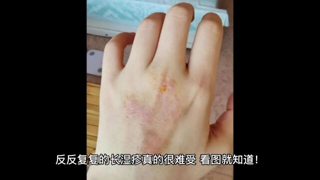 要不是这个方法我真的不知道湿疹该怎么办!