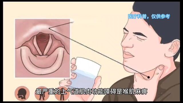 重症肌无力的症状表现