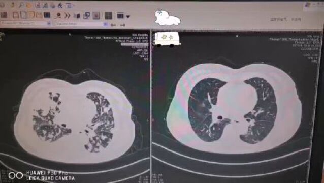 【医心为您】呼吸内科:个体化精细治疗 让肿瘤患者重获新生