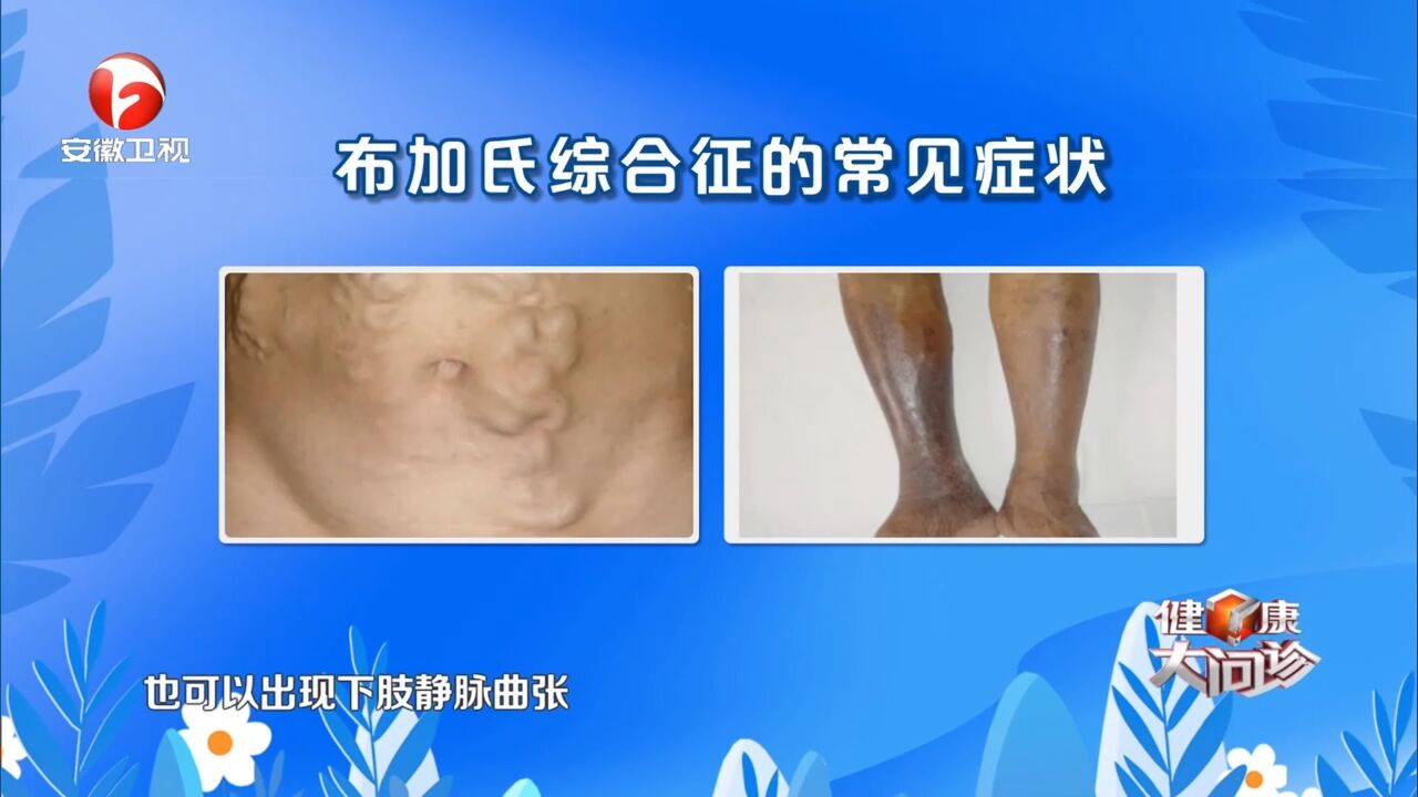 布加氏综合征主要症状有哪些,早期表现是什么?