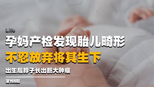 孕妈产检发现胎儿畸形,不忍放弃将其生下,出生脖子长出巨大肿瘤