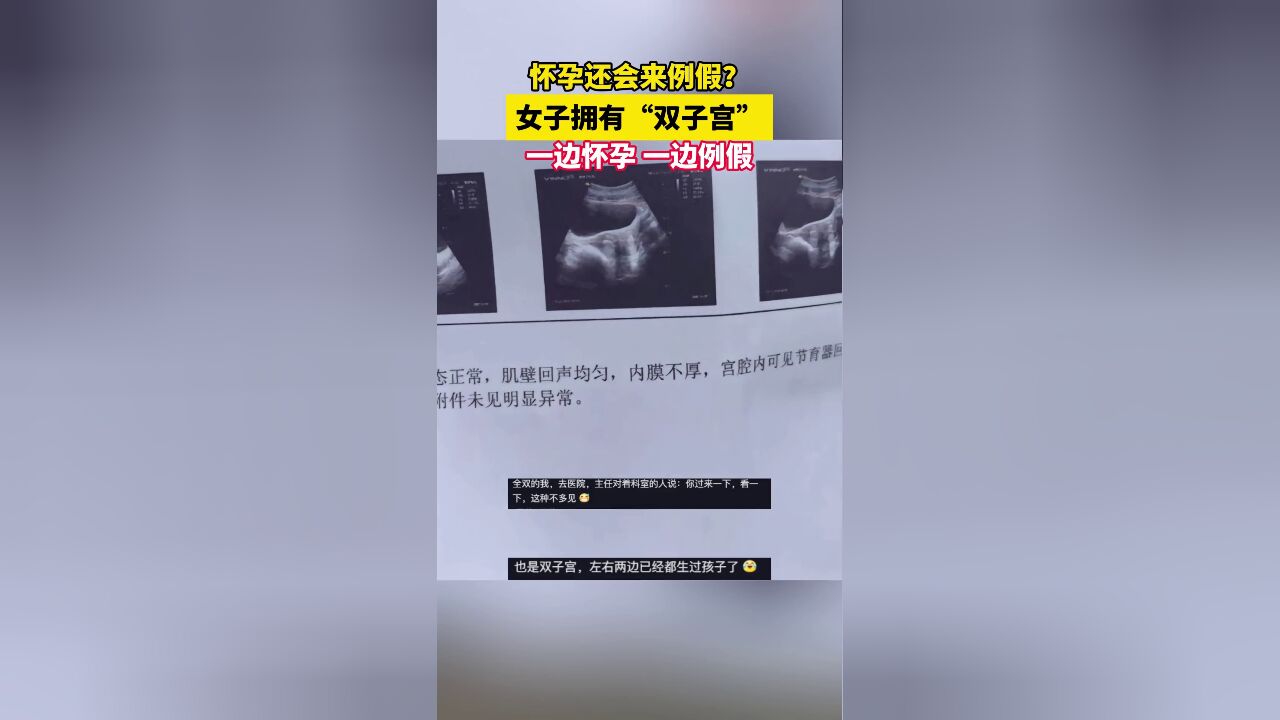 怀孕还会来例假?女子拥有“双子宫”,一边怀孕一边例假