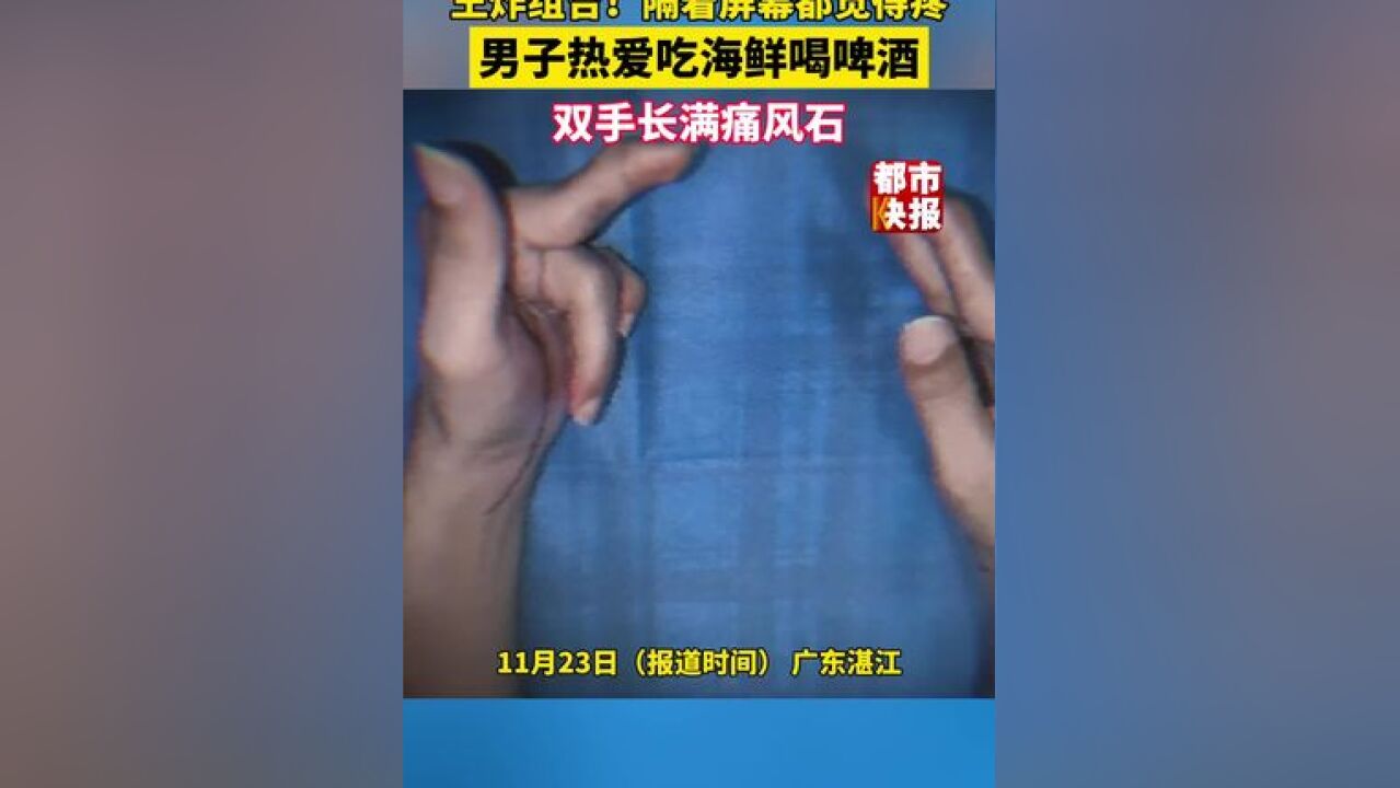 王炸组合!广东湛江一男子 喜欢吃海鲜喝啤酒,双手长满痛风石,隔着屏幕都觉得疼……