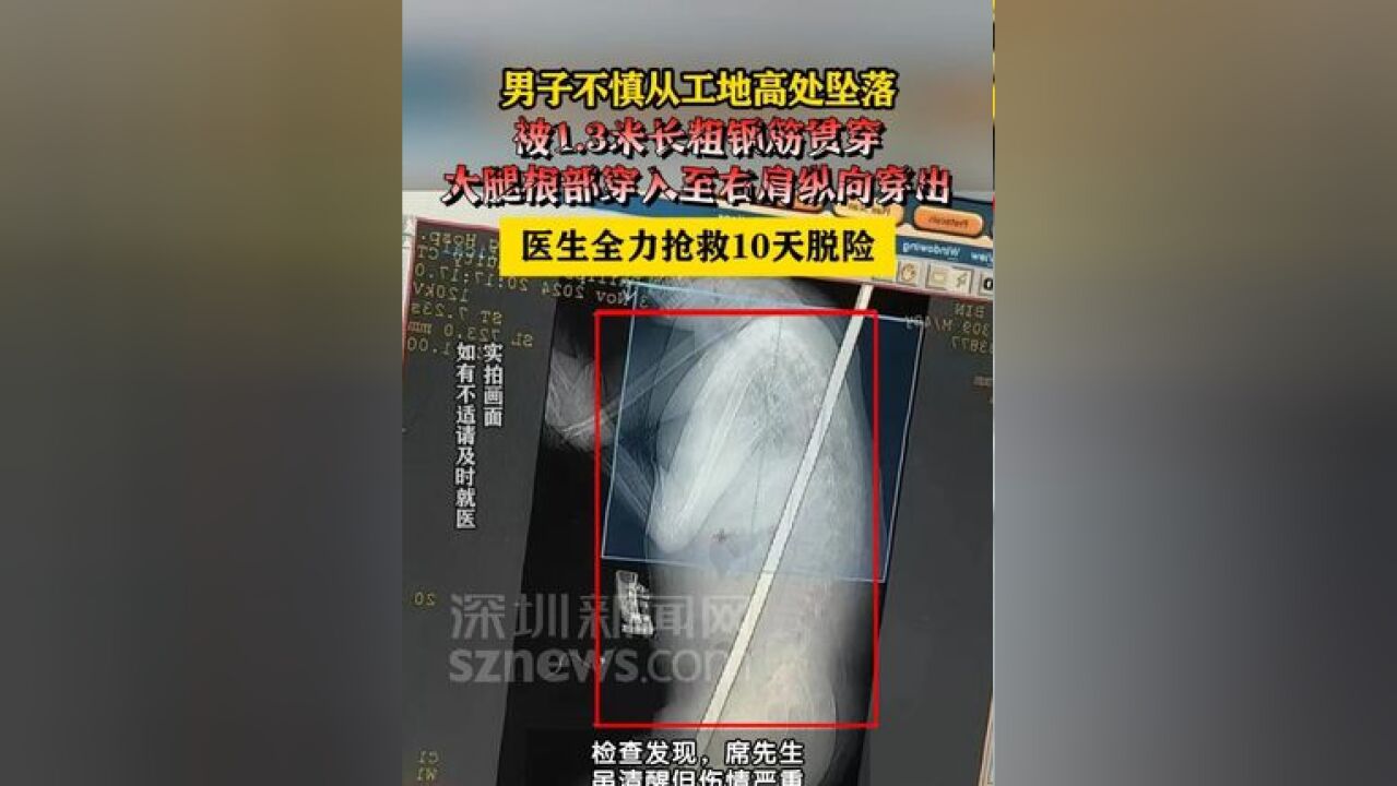 男子不慎高坠被钢筋贯穿胸腹腔抢救10天脱险