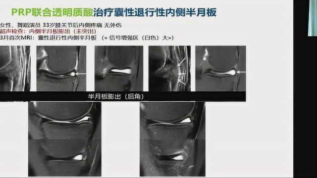 何逸康#PRP在运动损伤中的应用