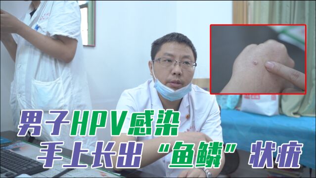 男子HPV感染,手上长出“鱼鳞”状疣,抠破还会传染