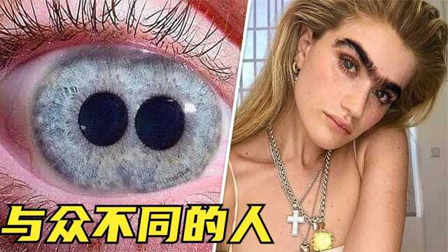 5个与众不同的人,有人天生两个瞳孔?有人眉毛连成一条线?