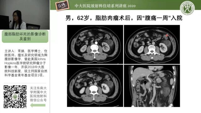 腹部脂肪坏死的影像诊断及鉴别中大常娣