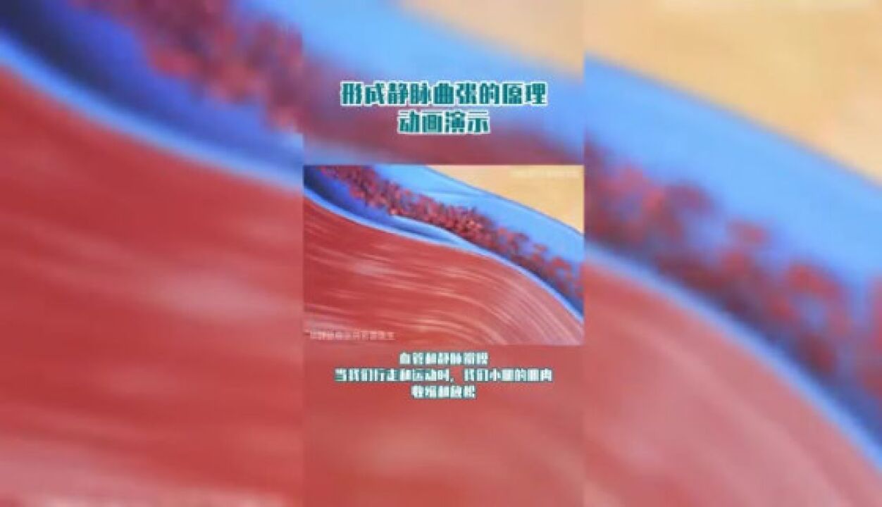 用动画告诉你什么是下肢静脉曲张