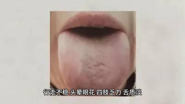 阳虚风动型颤病