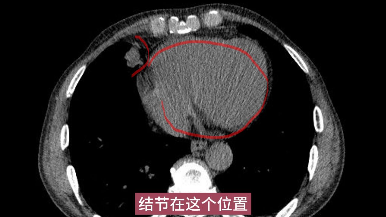 肺上长了结节,怎么看是不是肺癌?医生讲解1个实性肺结节