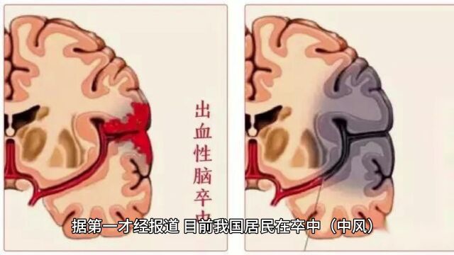 第一批90后已成为中风高发人群