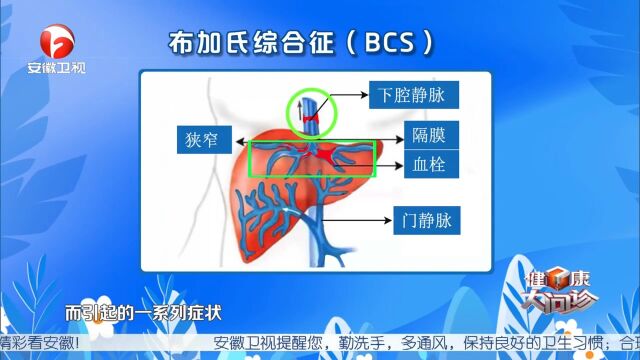 35岁左右成年男性要注意了,布加氏综合征的发病率有多高?