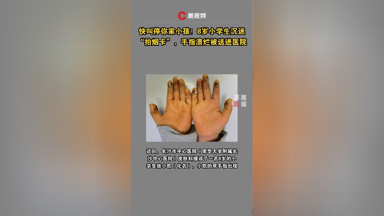 快叫停你家小孩!8岁小学生沉迷“拍烟卡”,手指溃烂被送进医院