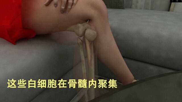 《我不是药神》中的慢粒白血病,这才是真正的死神