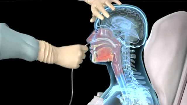 医学动画展示洗胃全过程,一米长的管子从你的嘴进入身体,听着都疼!