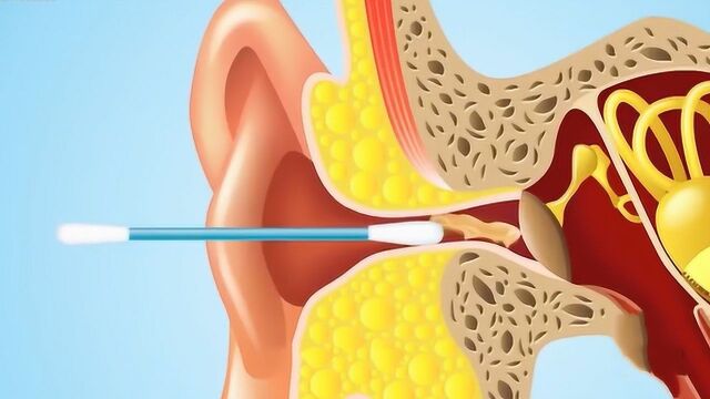很多人都用棉签掏耳朵,这样做到底安不安全?看完危害一目了然