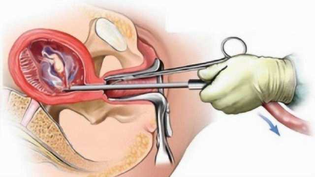 人流怎样“打掉”孩子的,3D动画还原全过程,女性需自爱!