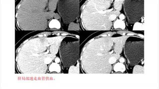 肝灌注异常影像分析