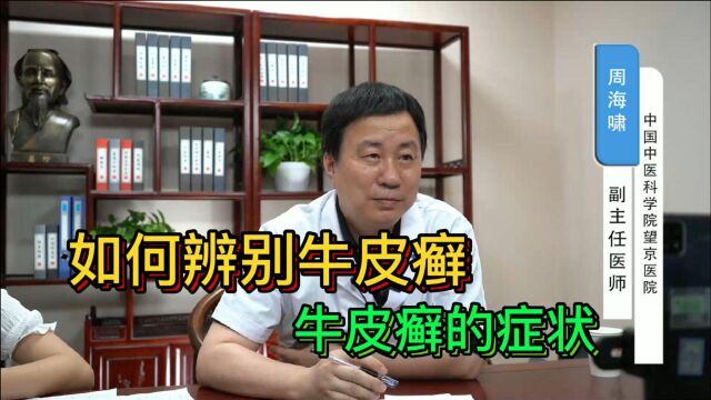 如何辨别牛皮癣的症状?听听主任怎么说