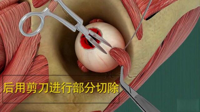 3D视频:眼睛斜视是怎么矫正的,快来看看吧!