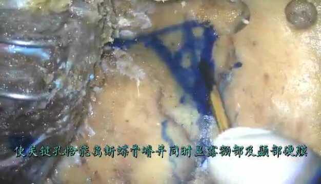 经眶上裂通道硬膜外切除海绵窦占位