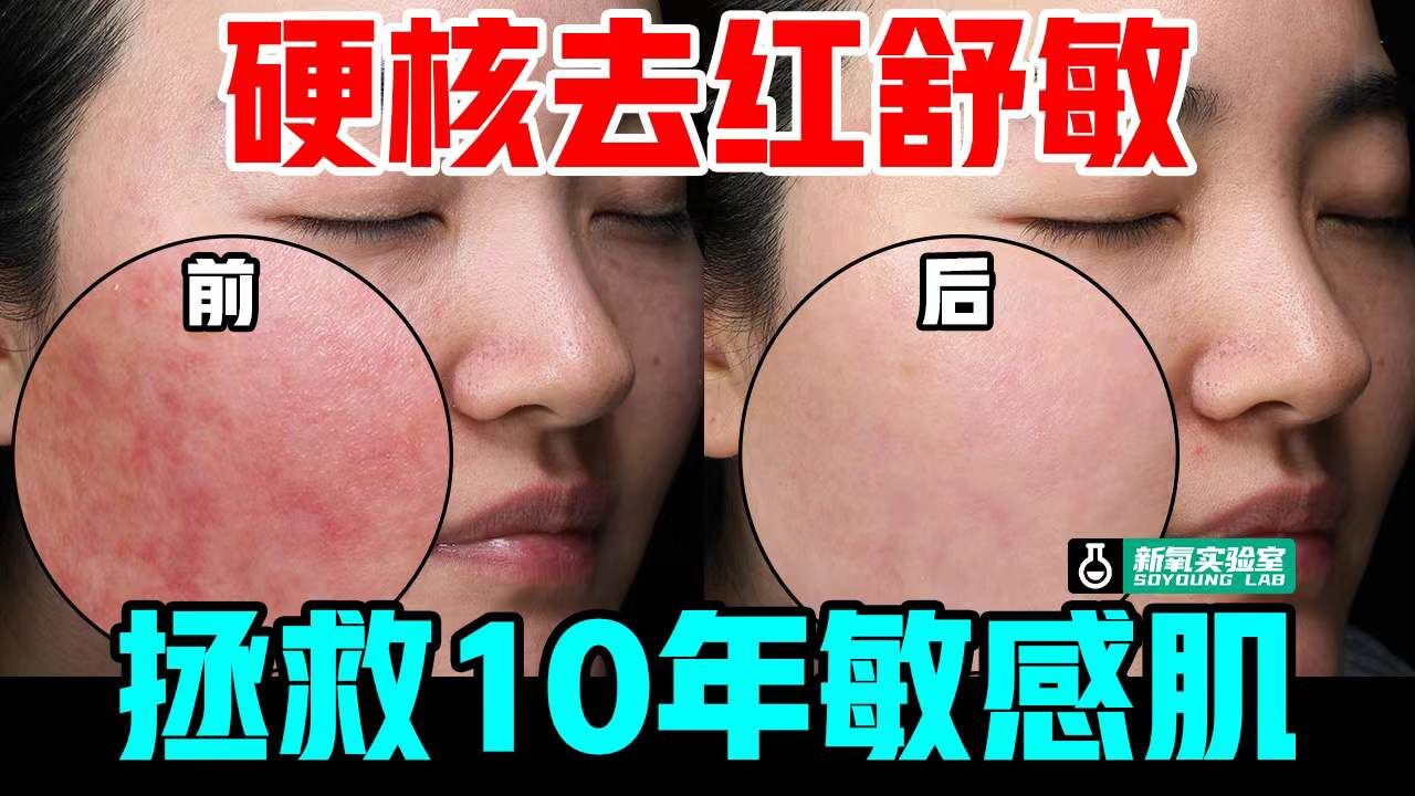 拯救敏敏肌!10年红脸蛋终于有希望了?